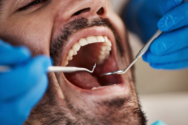 Best Emergency Tooth Extraction in Nevada, TX