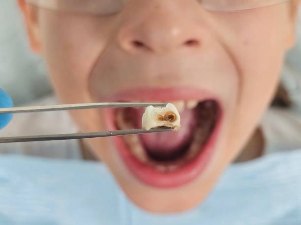 Best Emergency Treatment for Toothache in Nevada, TX
